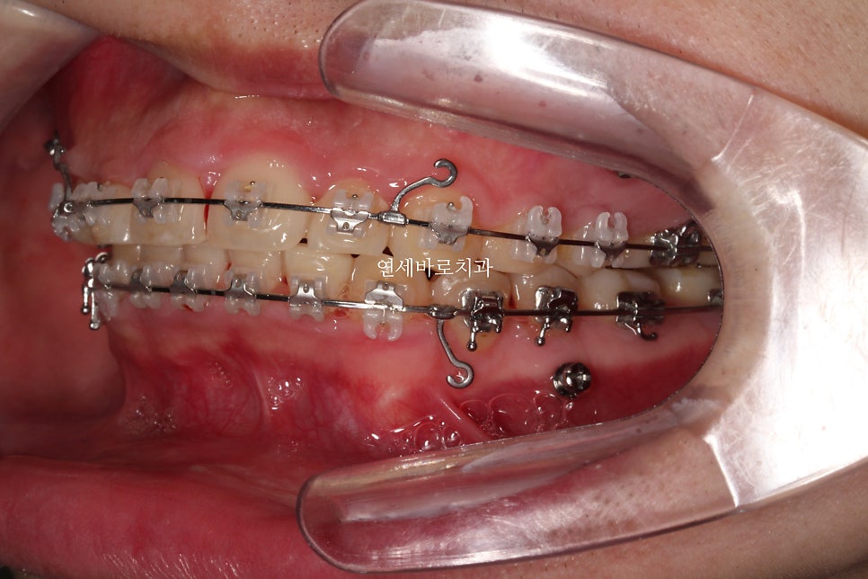 비발치로 얼마나 입을 넣을 수 있을까