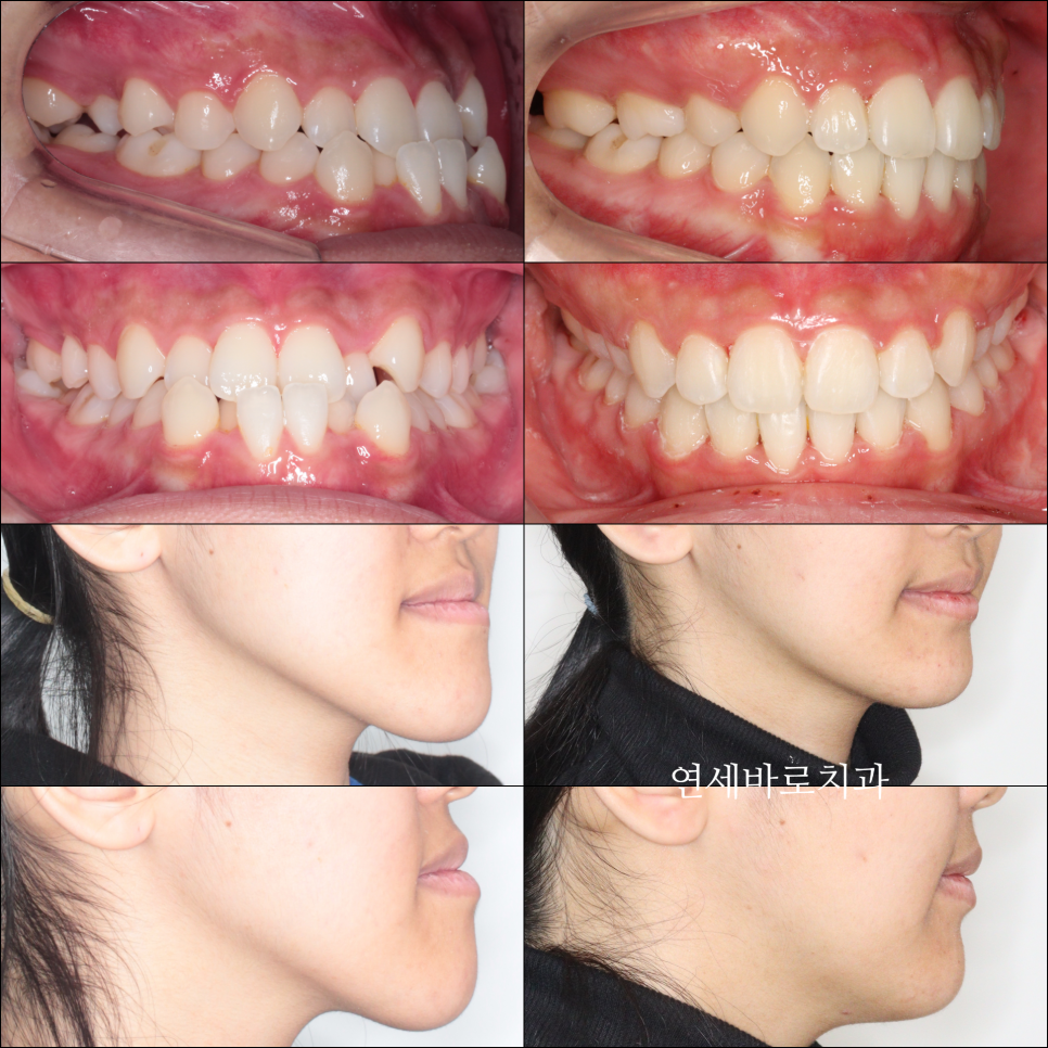구월동 교정치과 인비절라인 철사교정 모두 많이 하는 곳
