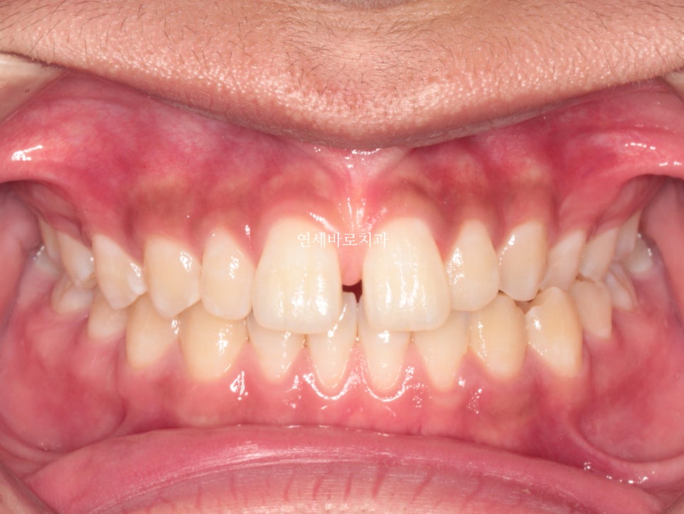 구월동 교정치과 인비절라인 철사교정 모두 많이 하는 곳