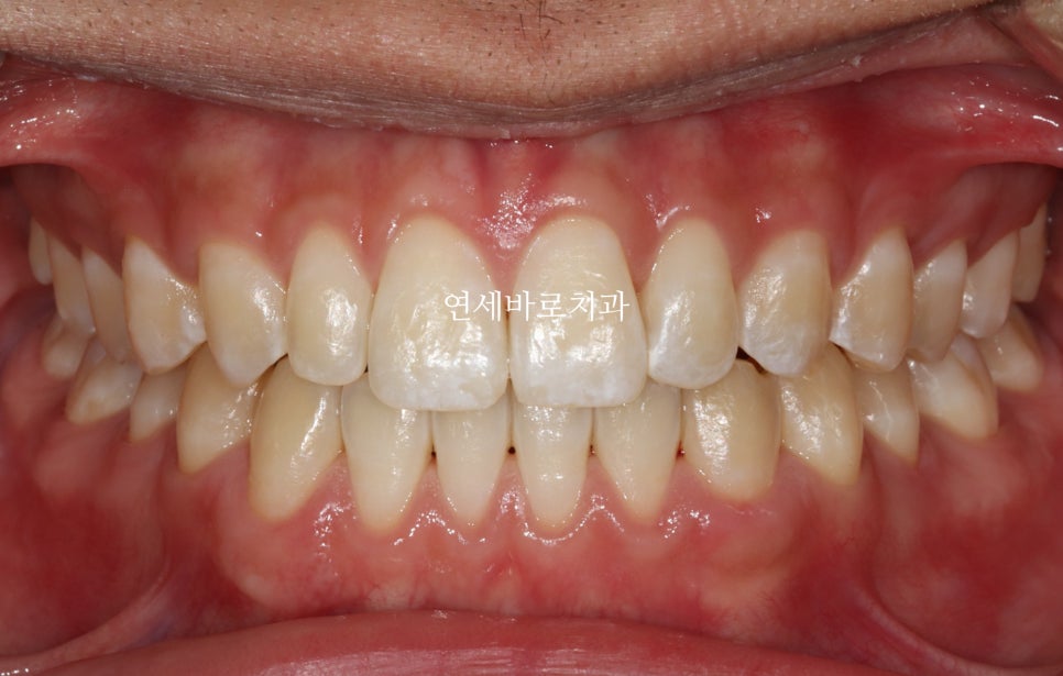구월동 교정치과 인비절라인 철사교정 모두 많이 하는 곳