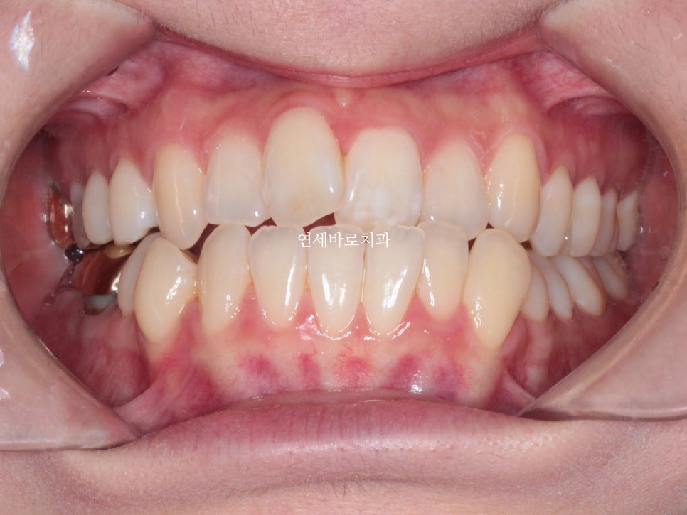 구월동 교정치과 인비절라인 철사교정 모두 많이 하는 곳