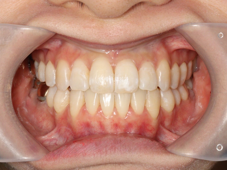 구월동 교정치과 인비절라인 철사교정 모두 많이 하는 곳