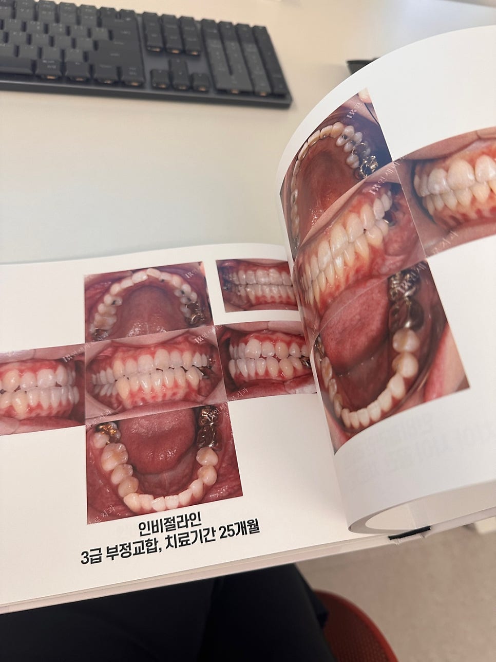 구월동 교정치과 인비절라인 철사교정 모두 많이 하는 곳