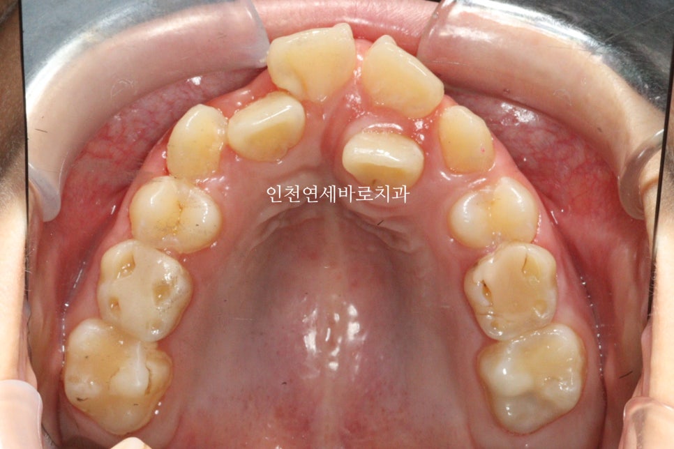 인비절라인 퍼스트 치료 전 후 비교 후기기록