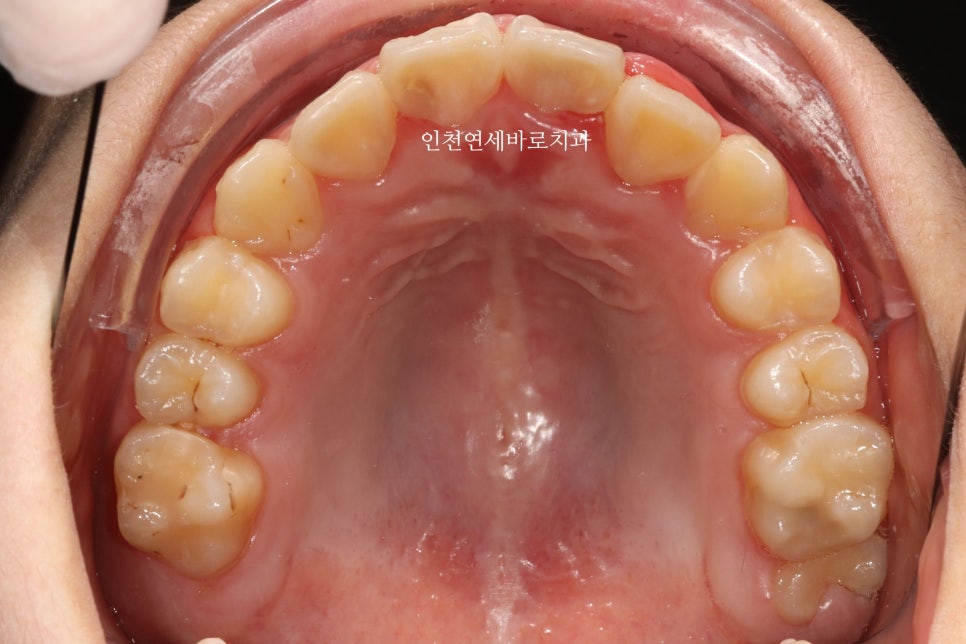인비절라인 퍼스트 치료 전 후 비교 후기기록