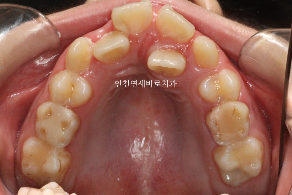 인비절라인 퍼스트 치료 전 후 비교 후기기록