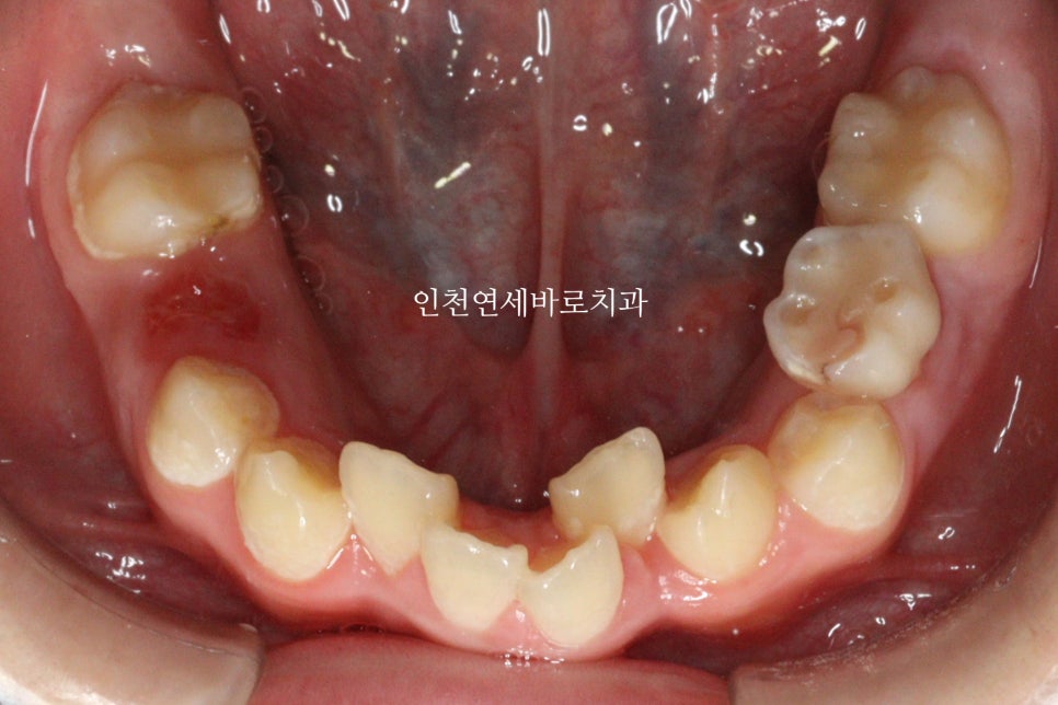 인비절라인 퍼스트 치료 전 후 비교 후기기록