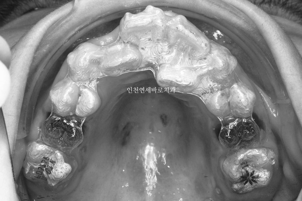 인비절라인 퍼스트 치료 전 후 비교 후기기록