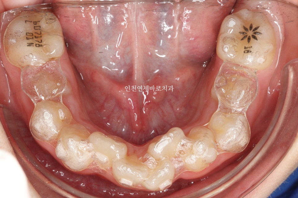 인비절라인 퍼스트 치료 전 후 비교 후기기록