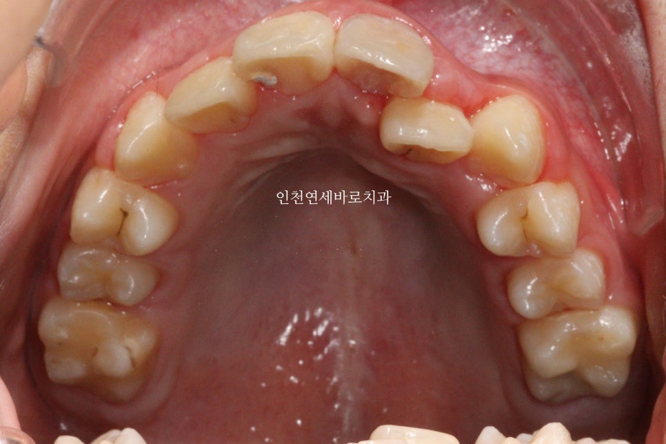 인비절라인 퍼스트 치료 전 후 비교 후기기록