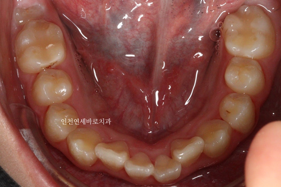 인비절라인 퍼스트 치료 전 후 비교 후기기록