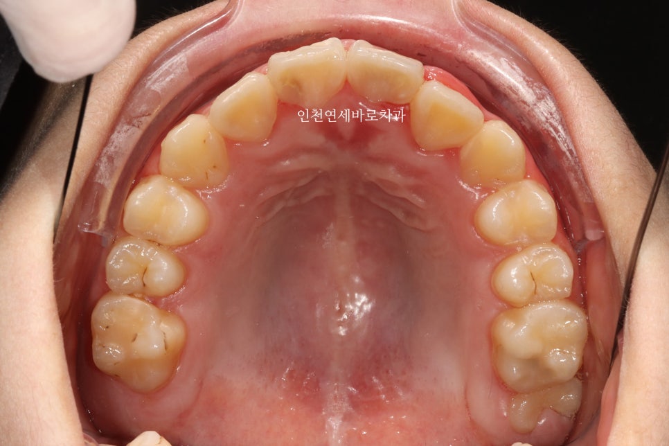 인비절라인 퍼스트 치료 전 후 비교 후기기록
