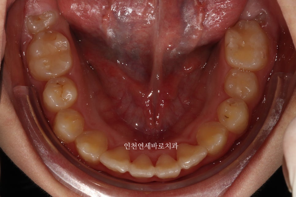 인비절라인 퍼스트 치료 전 후 비교 후기기록