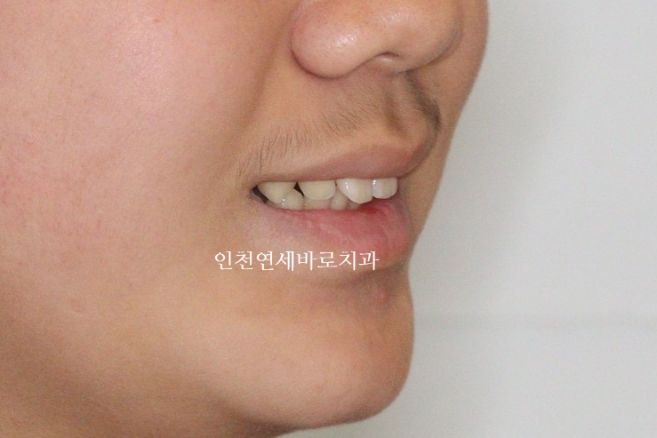 튀어나온 앞니의 부분교정은 인비절라인 라이트 로 진행하세요 치료 후기 기록