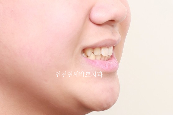 튀어나온 앞니의 부분교정은 인비절라인 라이트 로 진행하세요 치료 후기 기록