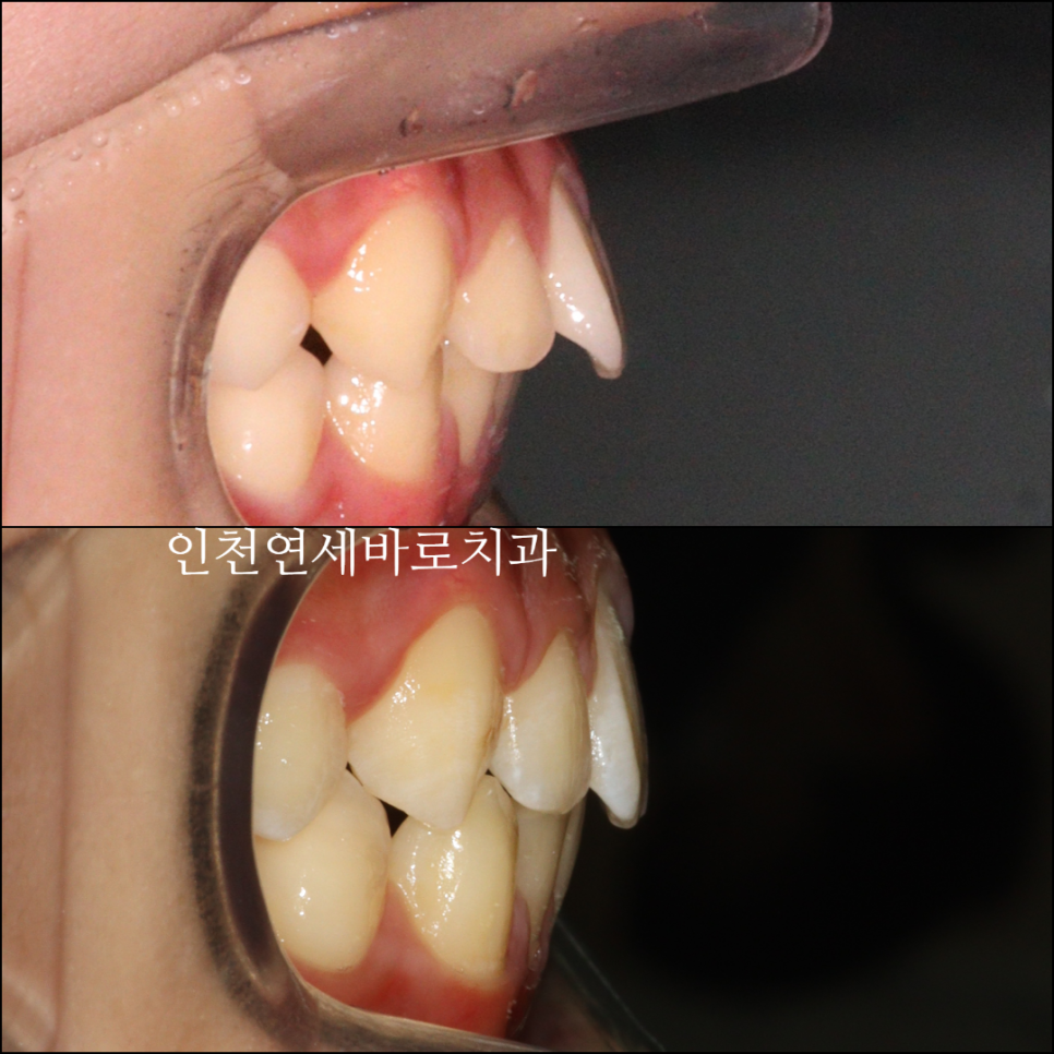튀어나온 앞니의 부분교정은 인비절라인 라이트 로 진행하세요 치료 후기 기록