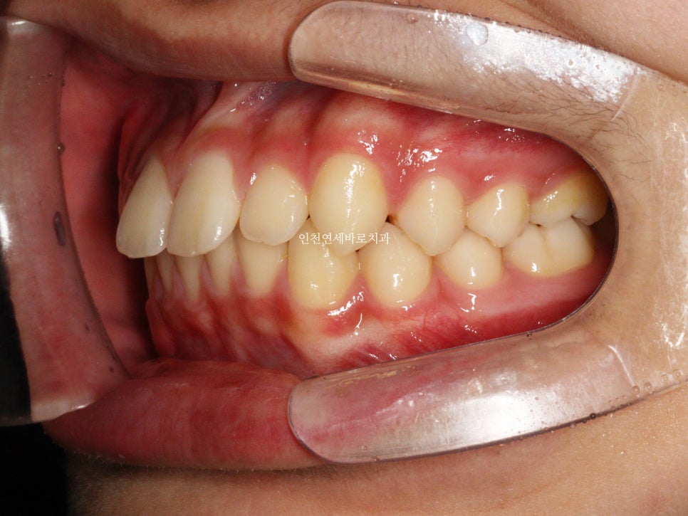 튀어나온 앞니의 부분교정은 인비절라인 라이트 로 진행하세요 치료 후기 기록