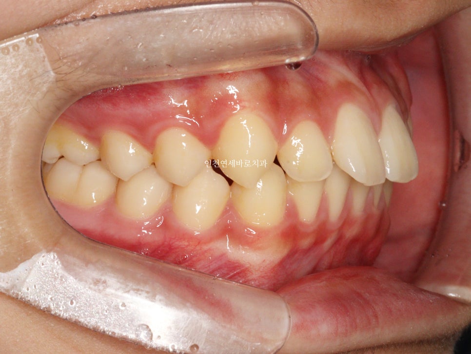 튀어나온 앞니의 부분교정은 인비절라인 라이트 로 진행하세요 치료 후기 기록