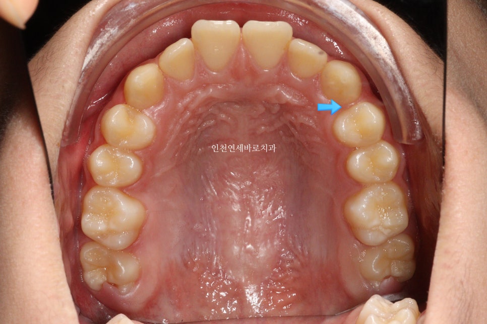 튀어나온 앞니의 부분교정은 인비절라인 라이트 로 진행하세요 치료 후기 기록