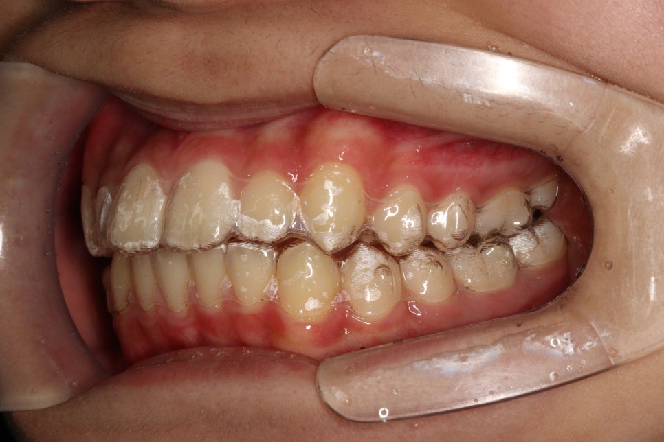 튀어나온 앞니의 부분교정은 인비절라인 라이트 로 진행하세요 치료 후기 기록