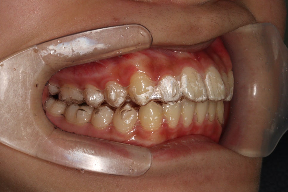 튀어나온 앞니의 부분교정은 인비절라인 라이트 로 진행하세요 치료 후기 기록