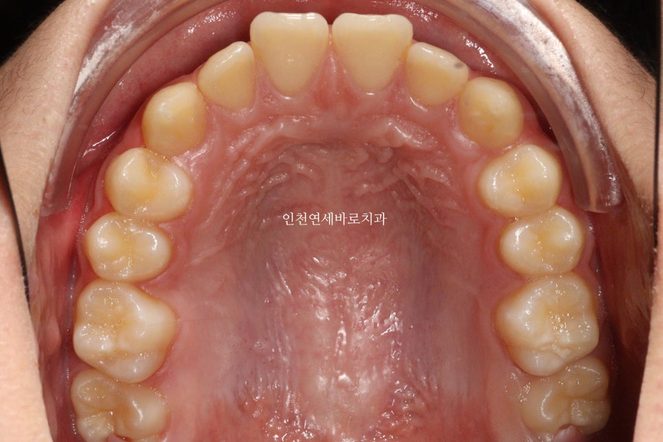 튀어나온 앞니의 부분교정은 인비절라인 라이트 로 진행하세요 치료 후기 기록