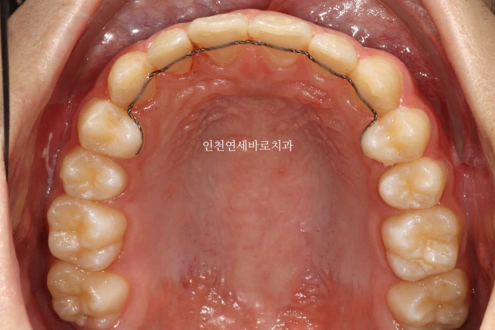 튀어나온 앞니의 부분교정은 인비절라인 라이트 로 진행하세요 치료 후기 기록