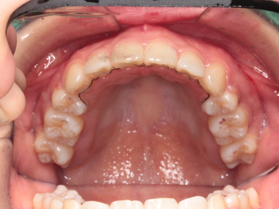 인천 교정치과 돌출입 교정치료 전 후 비교