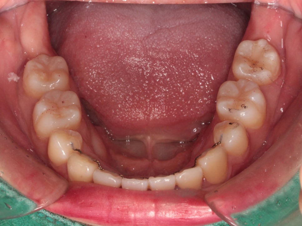 인천 교정치과 돌출입 교정치료 전 후 비교