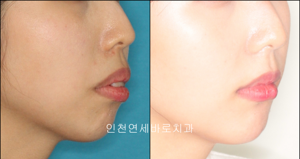 인천 교정치과 돌출입 교정치료 전 후 비교