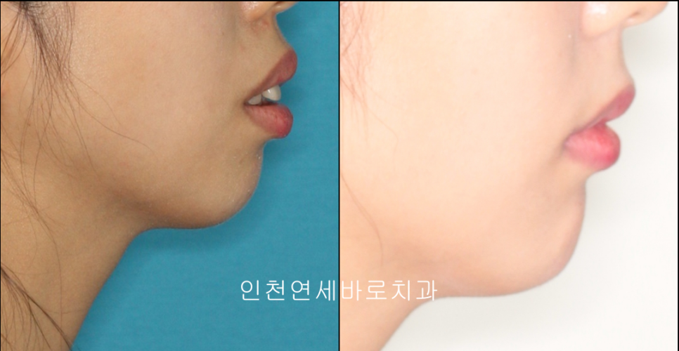인천 교정치과 돌출입 교정치료 전 후 비교