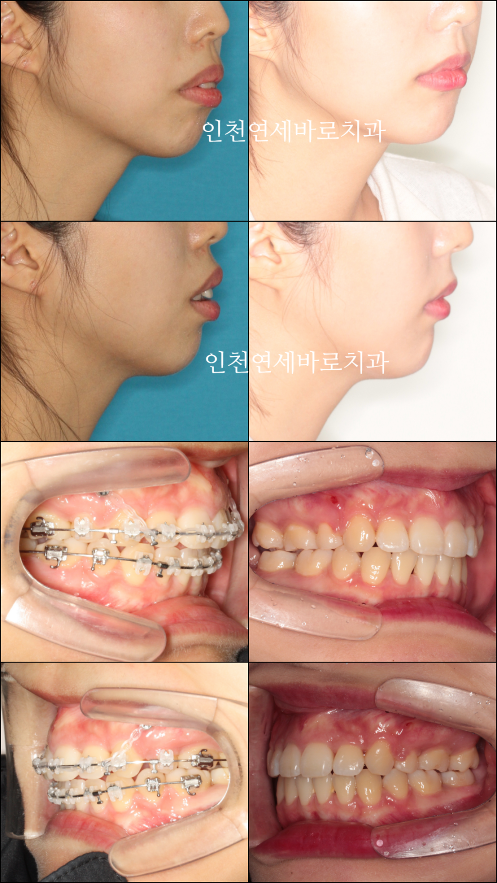 인천 교정치과 돌출입 교정치료 전 후 비교