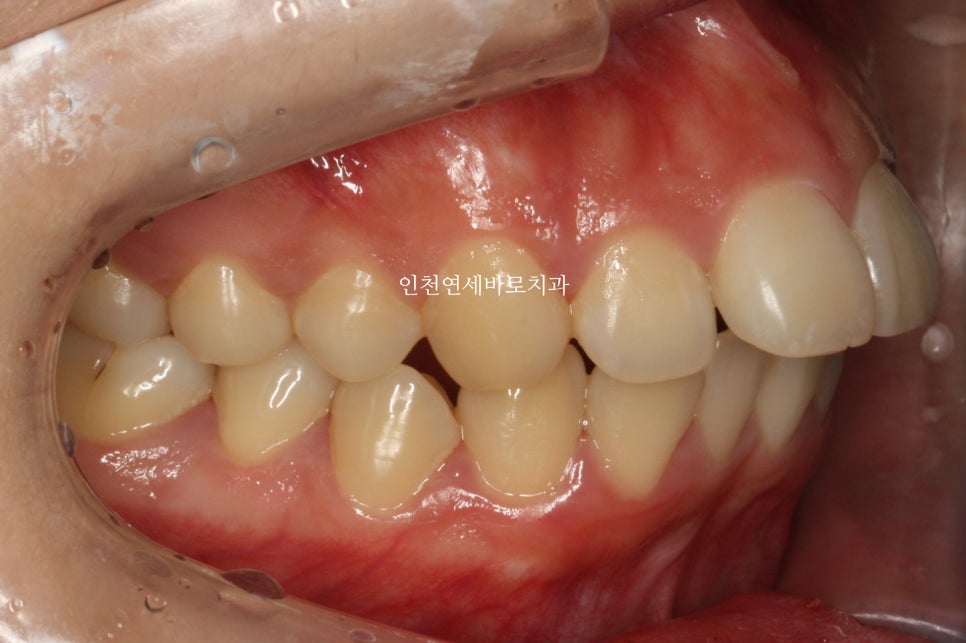 인천 교정치과 돌출입 교정치료 전 후 비교
