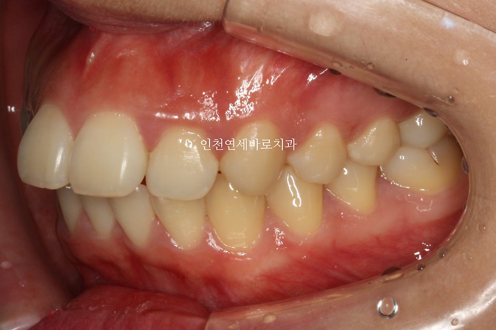 인천 교정치과 돌출입 교정치료 전 후 비교