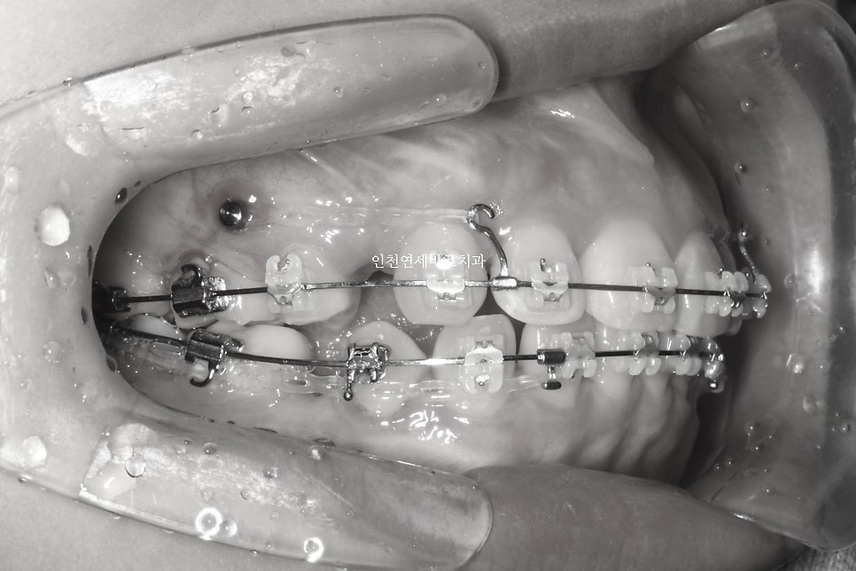 인천 교정치과 돌출입 교정치료 전 후 비교