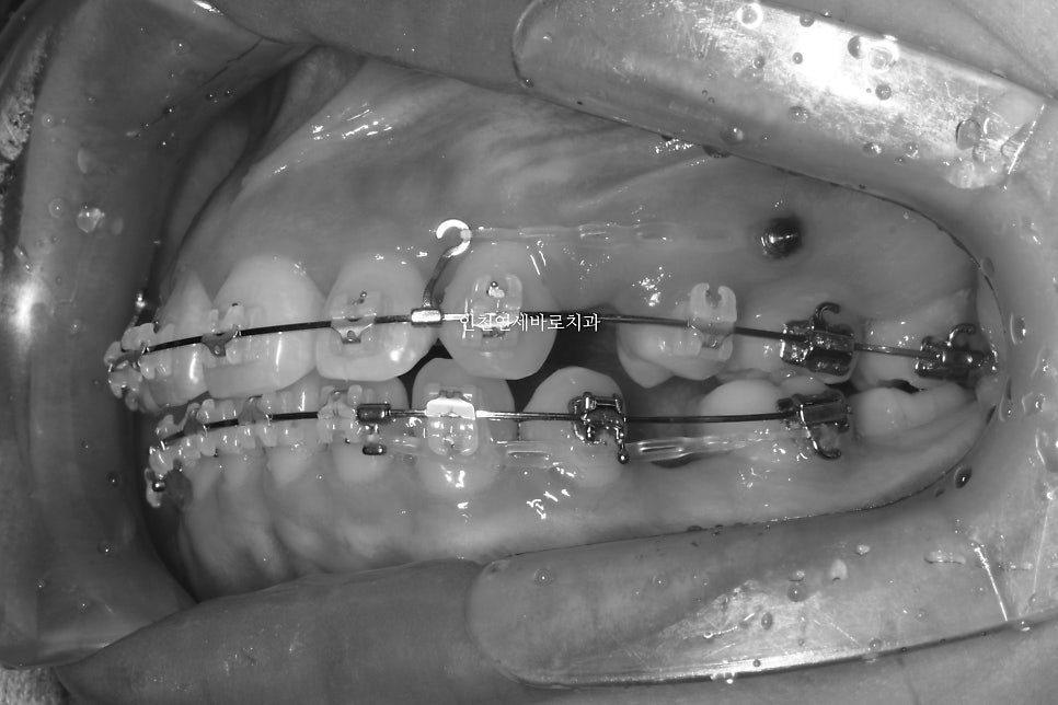 인천 교정치과 돌출입 교정치료 전 후 비교