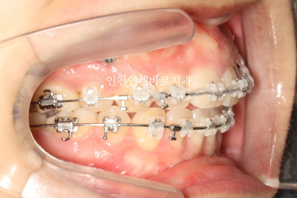 인천 교정치과 돌출입 교정치료 전 후 비교