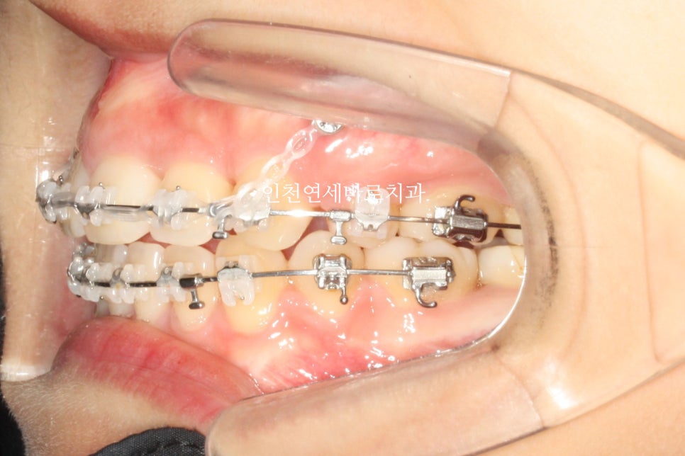 인천 교정치과 돌출입 교정치료 전 후 비교