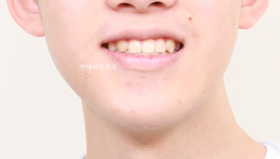 인천 어린이 교정치료, 선천적 치아결손 비대칭 5년에 걸친 치료 기록 후기