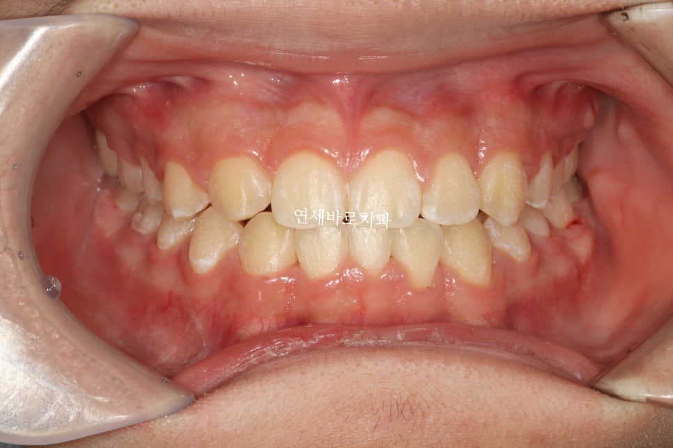 인천 어린이 교정치료, 선천적 치아결손 비대칭 5년에 걸친 치료 기록 후기