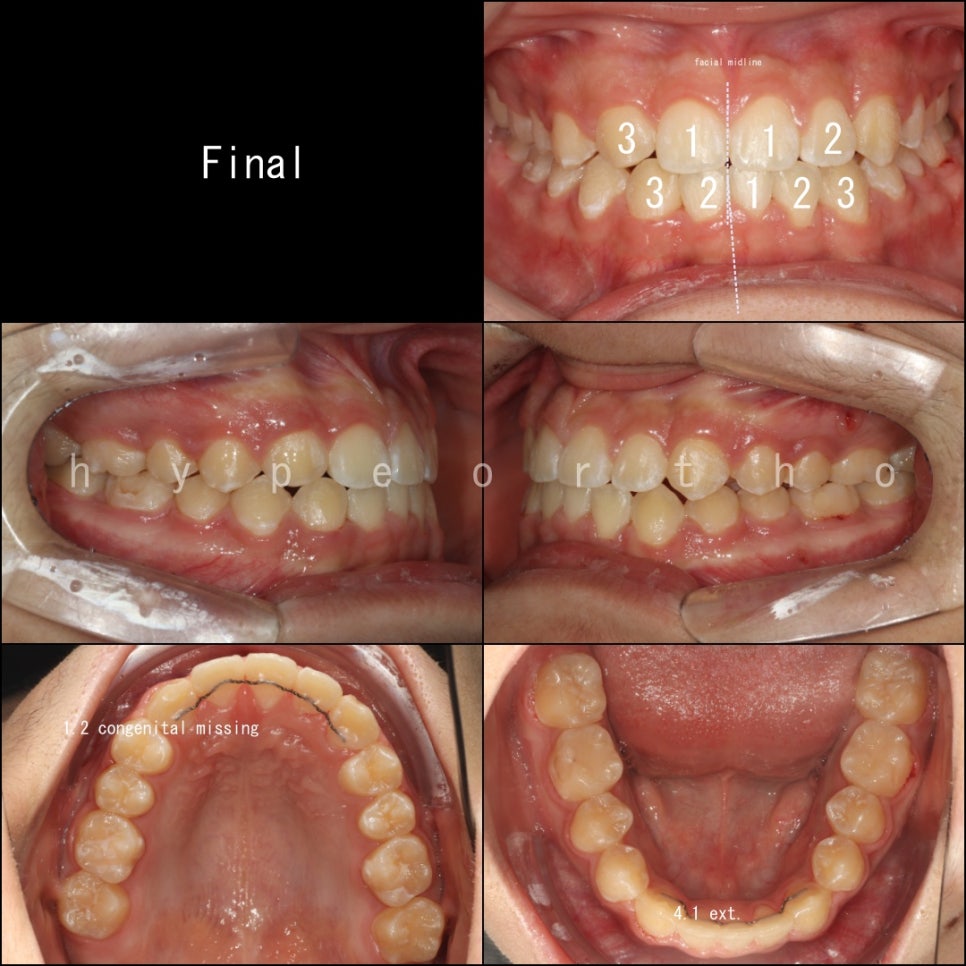 인천 어린이 교정치료, 선천적 치아결손 비대칭 5년에 걸친 치료 기록 후기
