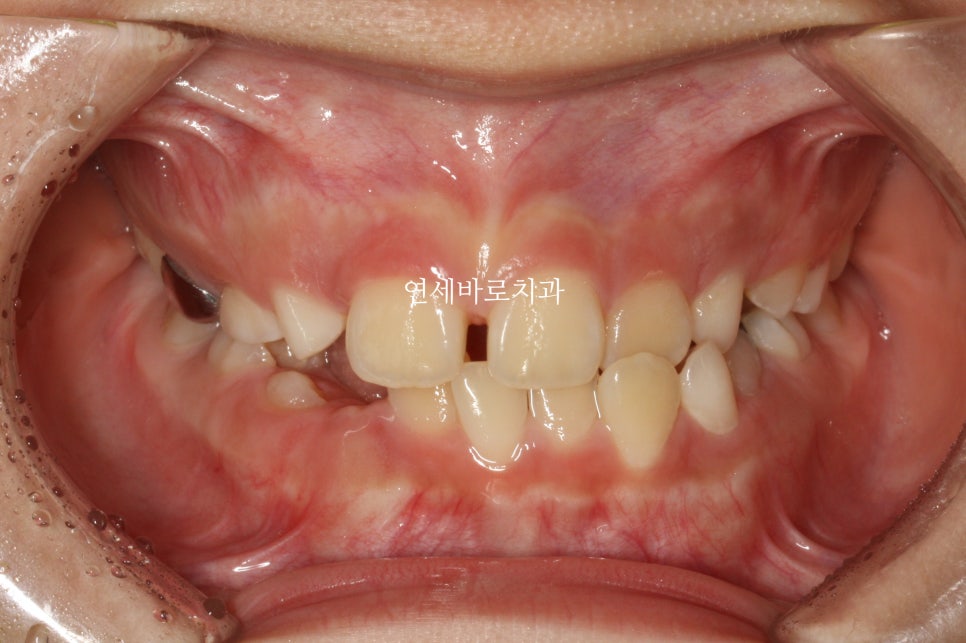 인천 어린이 교정치료, 선천적 치아결손 비대칭 5년에 걸친 치료 기록 후기