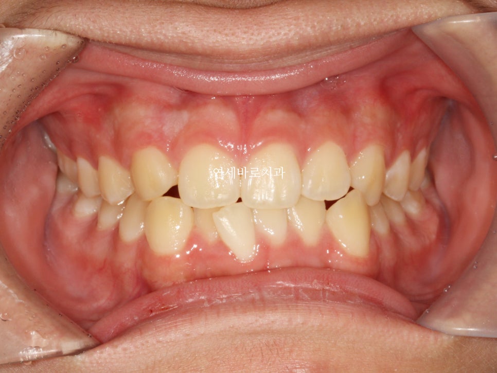인천 어린이 교정치료, 선천적 치아결손 비대칭 5년에 걸친 치료 기록 후기