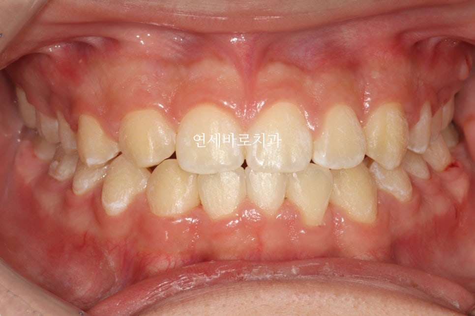 인천 어린이 교정치료, 선천적 치아결손 비대칭 5년에 걸친 치료 기록 후기