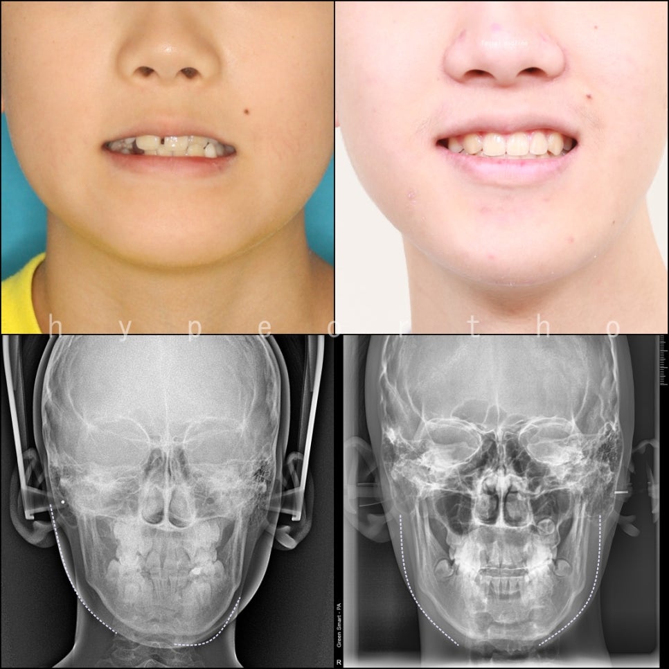 인천 어린이 교정치료, 선천적 치아결손 비대칭 5년에 걸친 치료 기록 후기