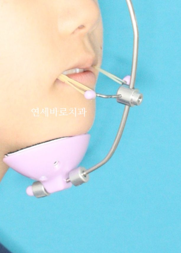 인천 어린이 교정치료, 선천적 치아결손 비대칭 5년에 걸친 치료 기록 후기