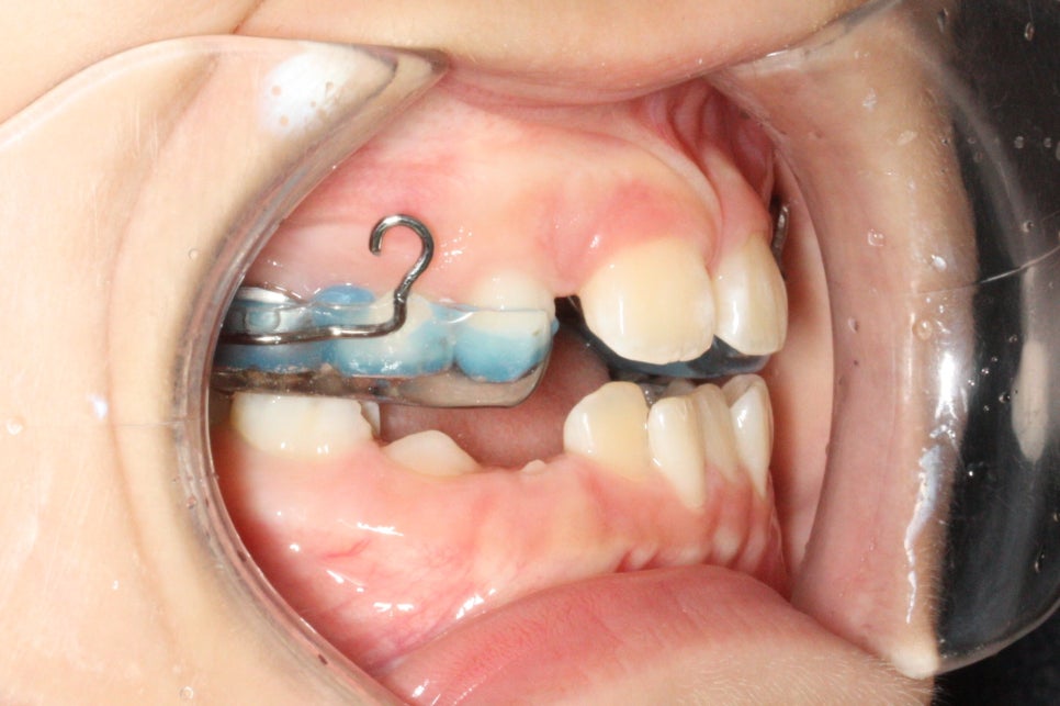 인천 어린이 교정치료, 선천적 치아결손 비대칭 5년에 걸친 치료 기록 후기