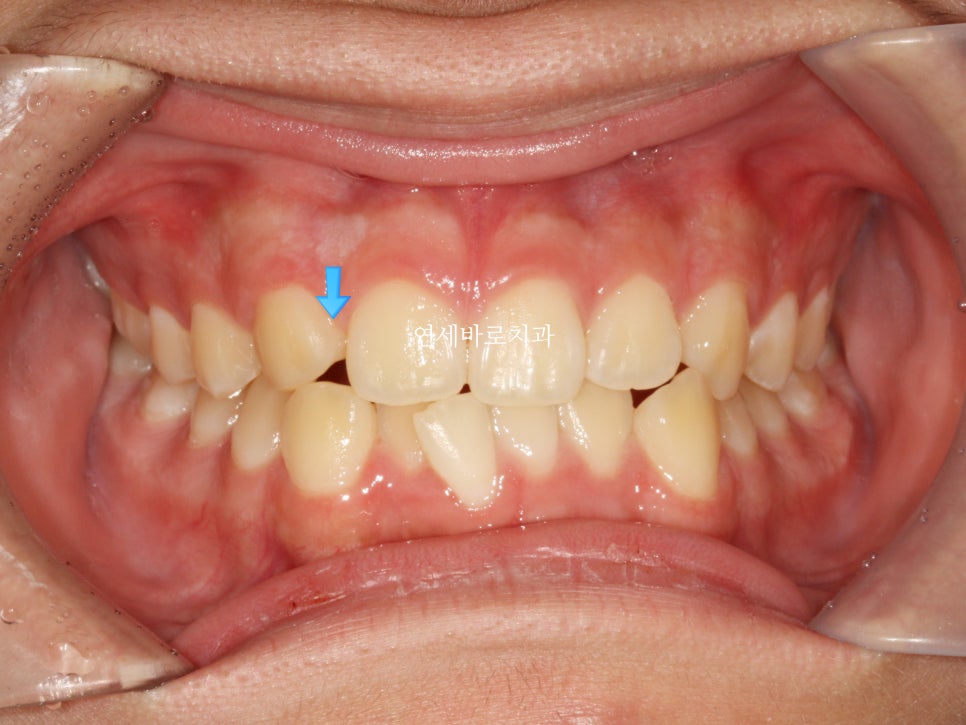 인천 어린이 교정치료, 선천적 치아결손 비대칭 5년에 걸친 치료 기록 후기