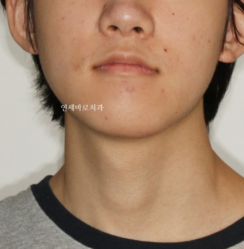 인천 어린이 교정치료, 선천적 치아결손 비대칭 5년에 걸친 치료 기록 후기