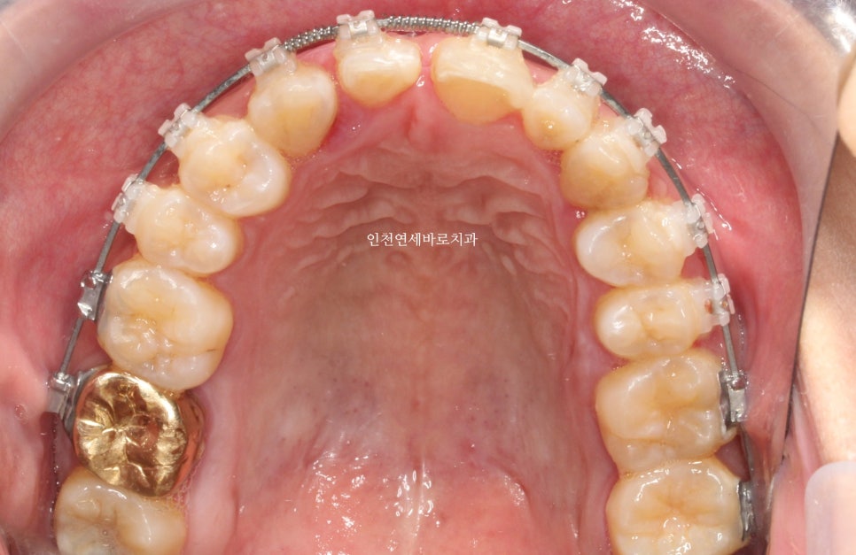 앞니가 부러진 경우 임플란트 안하는 방법